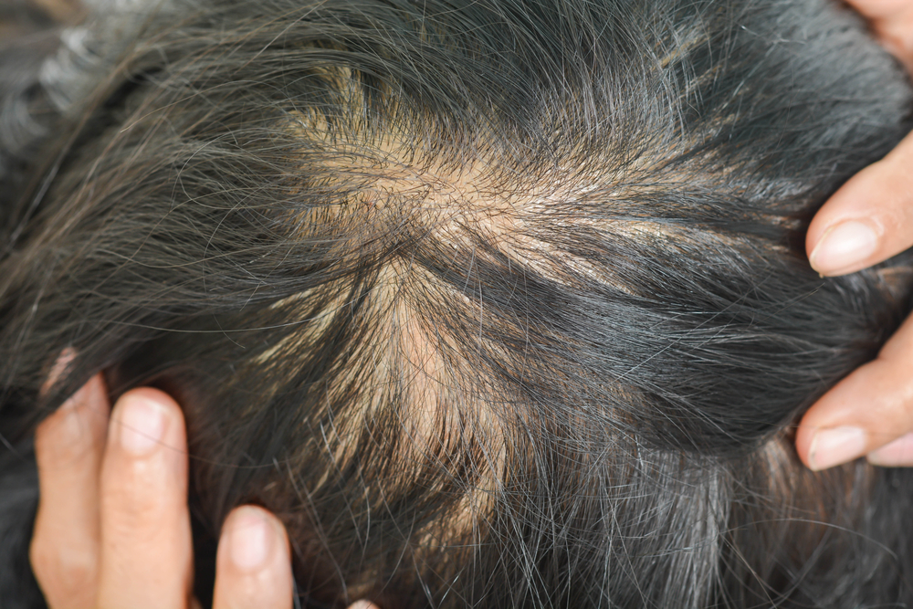 Factors that affect hair loss 