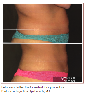 Before and after the Core-to-Floor procedure.PNG