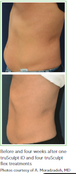 Before and four weeks after one truSculpt iD and four truSculpt flex treatments.PNG