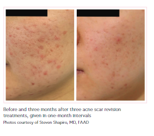 Before and three months after three acne scar revision treatments, given in one-month intervals.PNG