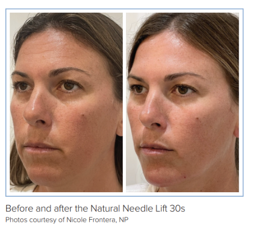 The Natural Needle Lift by Decade