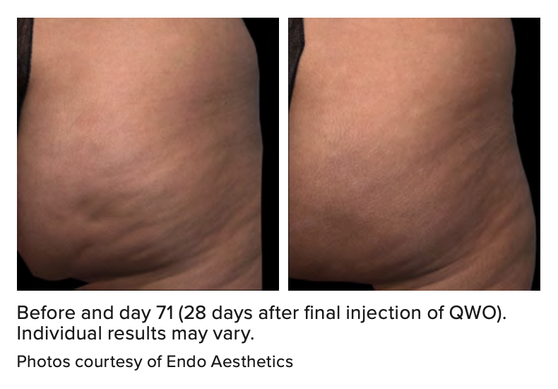 Before and day 71 (28 days after final injection of QWO). Individual results may vary. Photos courtesy of Endo Aesthetics