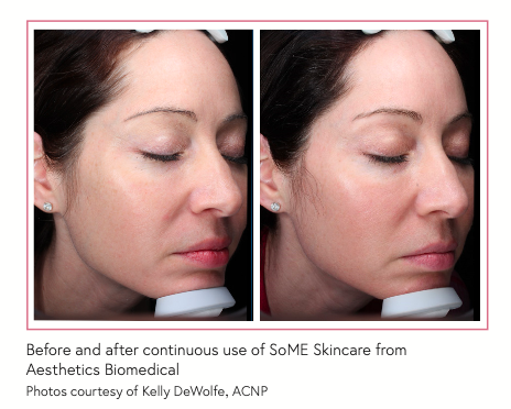 Before and after continuous use of SoME Skincare from Aesthetics Biomedical Photos courtesy of Kelly DeWolfe, ACNP