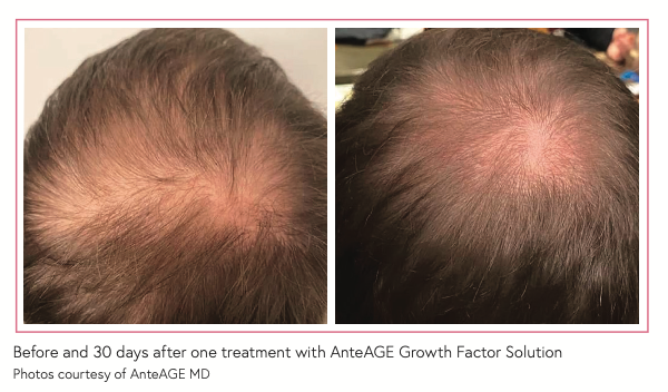 Before and 30 days after one treatment with AnteAGE Growth Factor Solution Photos courtesy of AnteAGE MD