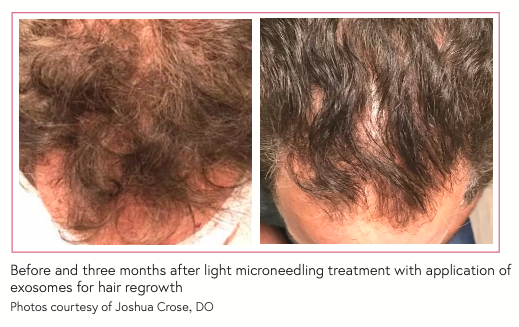 Before and three months after light microneedling treatment with application of exosomes for hair regrowth Photos courtesy of Joshua Crose, DO