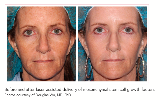 Before and after laser-assisted delivery of mesenchymal stem cell growth factors Photos courtesy of Douglas Wu, MD, PhD