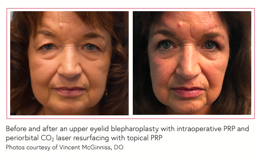 Before and after an upper eyelid blepharoplasty with intraoperative PRP and periorbital CO2 laser resurfacing with topical PRP Photos courtesy of Vincent McGinniss, DO
