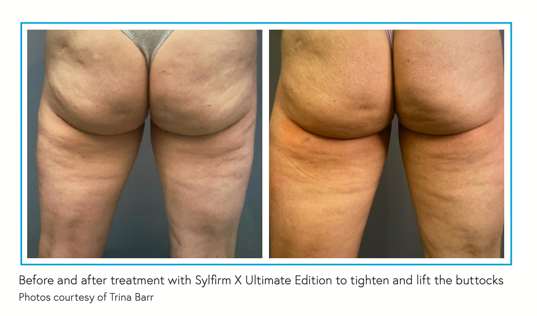 Before and after treatment with Sylfirm X Ultimate Edition to tighten and lift the buttocks Photos courtesy of Trina Barr