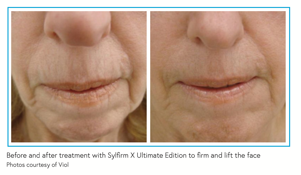 Before and after treatment with Sylfirm X Ultimate Edition to firm and lift the face Photos courtesy of Viol