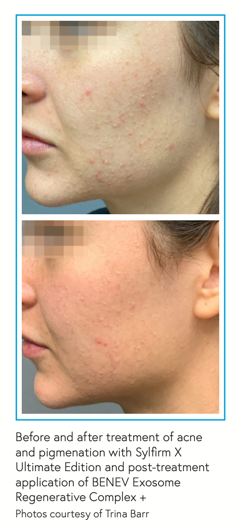Before and after treatment of acne and pigmenation with Sylfirm X Ultimate Edition and post-treatment application of BENEV Exosome Regenerative Complex + Photos courtesy of Trina Barr