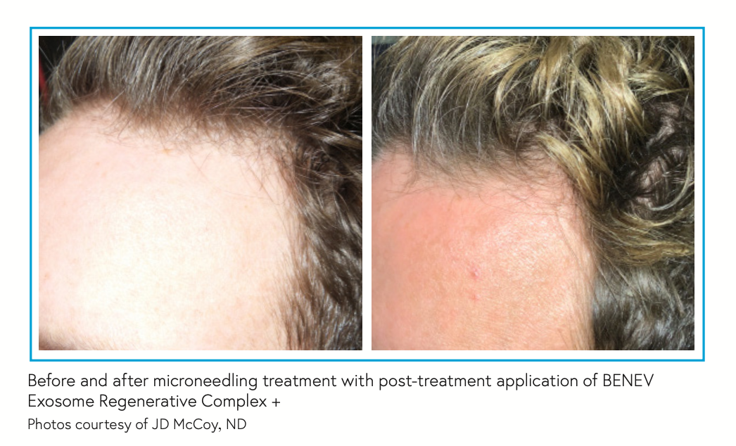 Before and after microneedling treatment with post-treatment application of BENEV Exosome Regenerative Complex + Photos courtesy of JD McCoy, ND