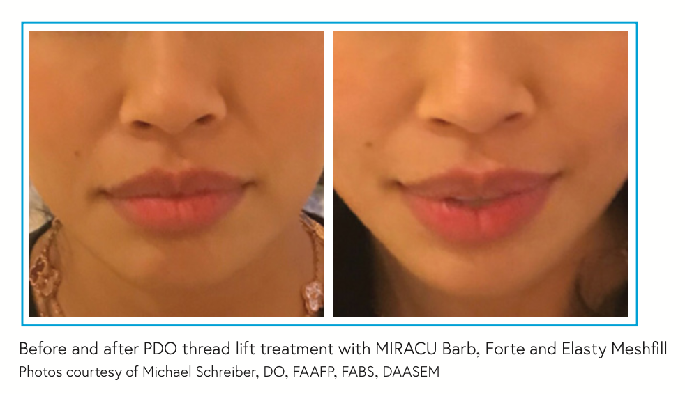 Before and after PDO thread lift treatment with MIRACU Barb, Forte and Elasty Meshfill Photos courtesy of Michael Schreiber, DO, FAAFP, FABS, DAASEM