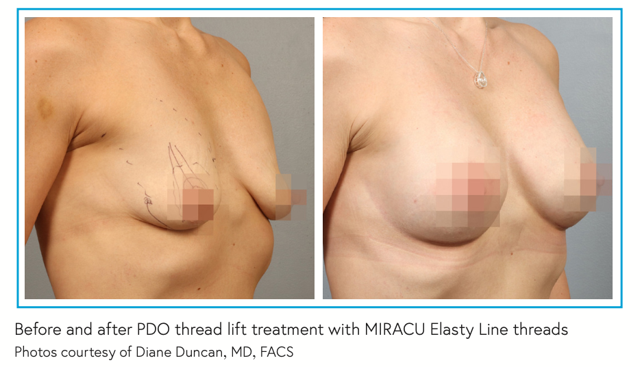 Before and after PDO thread lift treatment with MIRACU Elasty Line threads Photos courtesy of Diane Duncan, MD, FACS