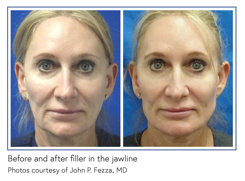 Before and after filler in the jawline Photos courtesy of John P. Fezza, MD