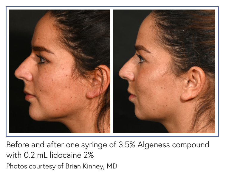 Before and after one syringe of 3.5% Algeness compound with 0.2 mL lidocaine 2% Photos courtesy of Brian Kinney, MD