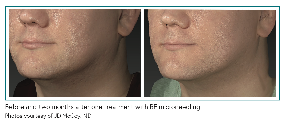 Before and two months after one treatment with RF microneedling Photos courtesy of JD McCoy, ND