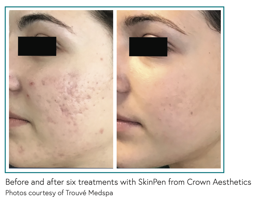  Before and after six treatments with SkinPen from Crown Aesthetics Photos courtesy of Trouvé Medspa