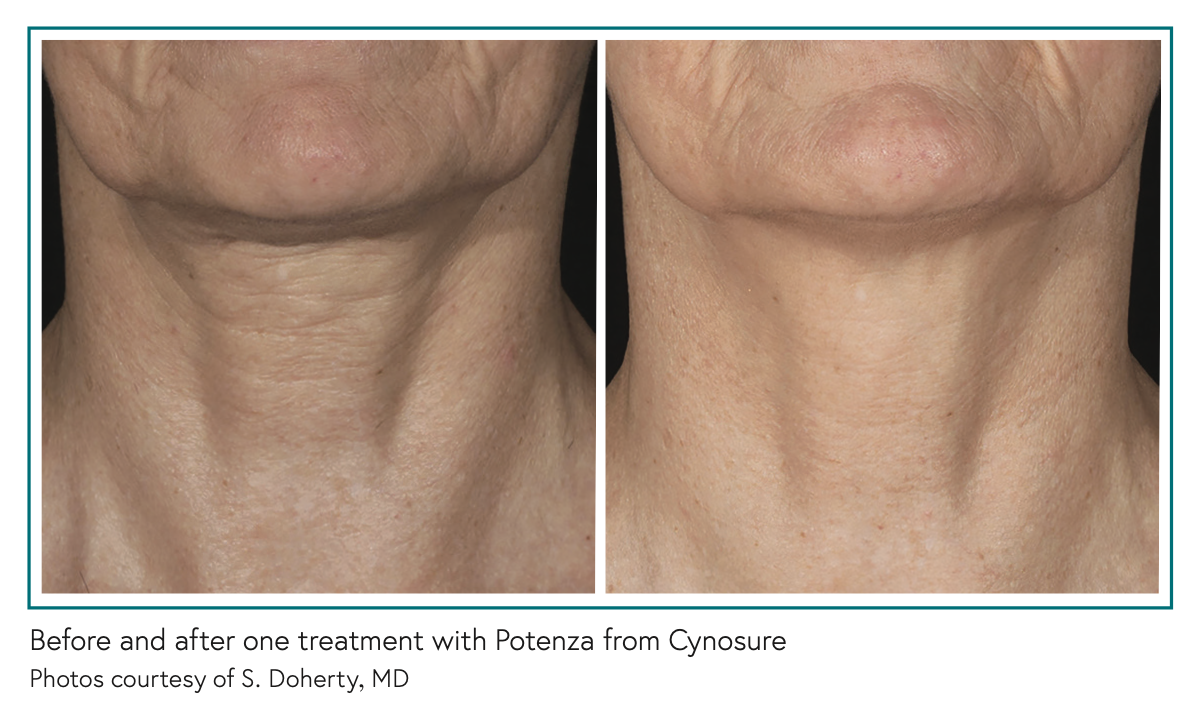 Before and after one treatment with Potenza from Cynosure Photos courtesy of S. Doherty, MD