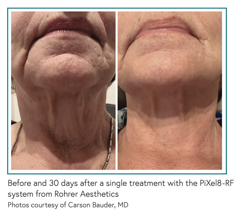 Before and 30 days after a single treatment with the PiXel8-RF system from Rohrer Aesthetics Photos courtesy of Carson Bauder, MD