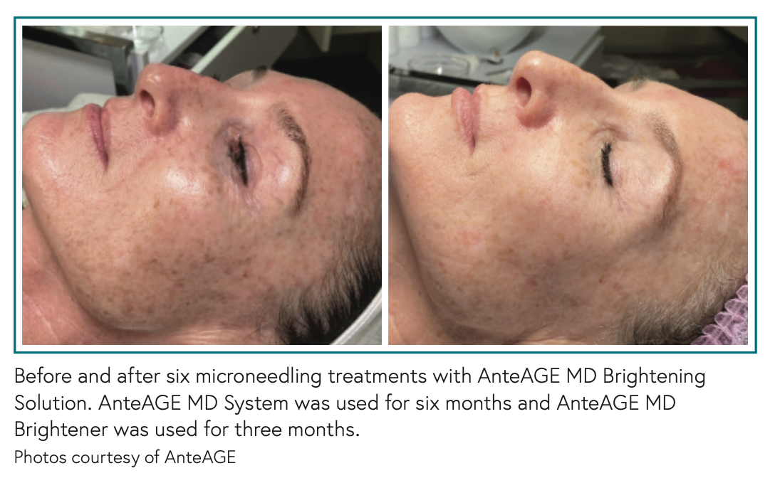 Before and after six microneedling treatments with AnteAGE MD Brightening Solution. AnteAGE MD 