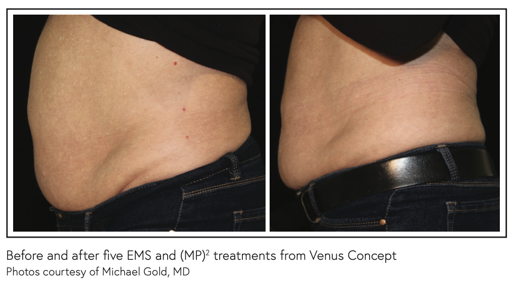 Trend watch EMS fat-reduction and muscle stimulation treatments